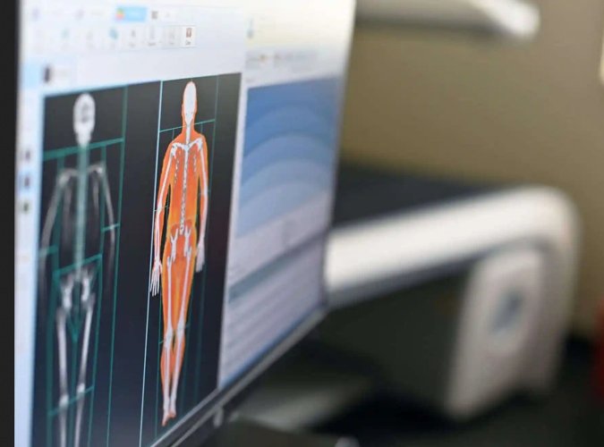 Cuando hacerse una densitometría ósea