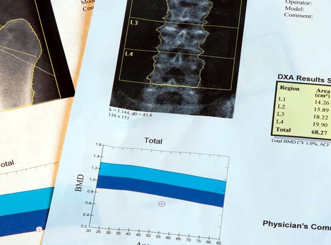 Para qué sirve la densitometría ósea